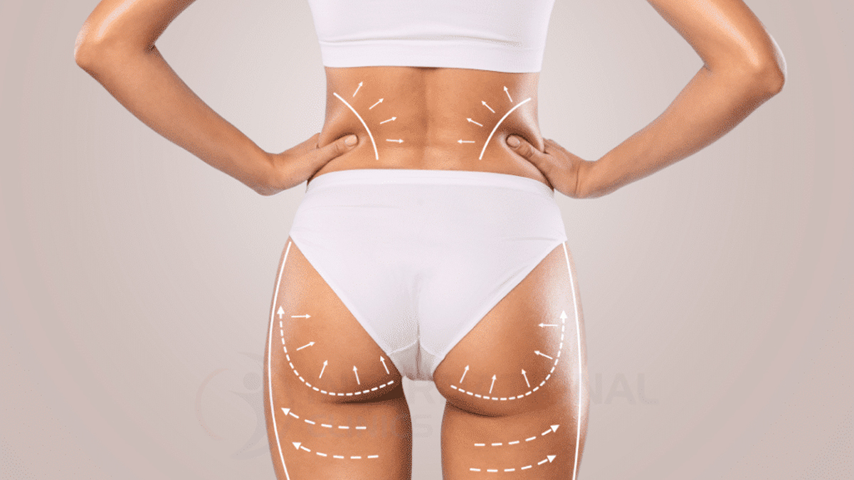 Back Liposuction in turkey