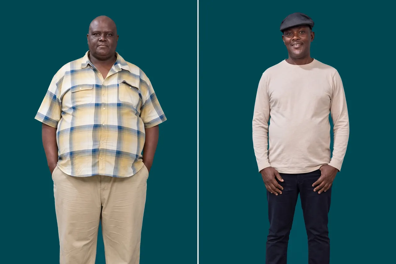 Weight Loss Surgery-Gastric Sleeve 1