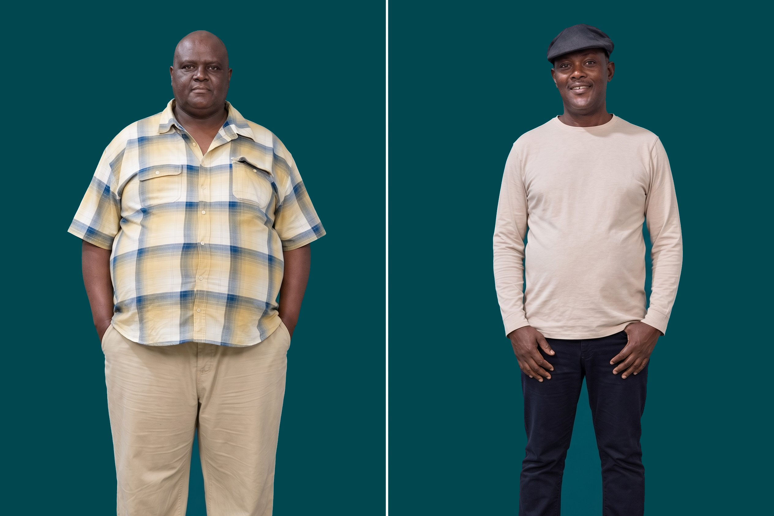 Weight Loss Surgery-Gastric Sleeve 1
