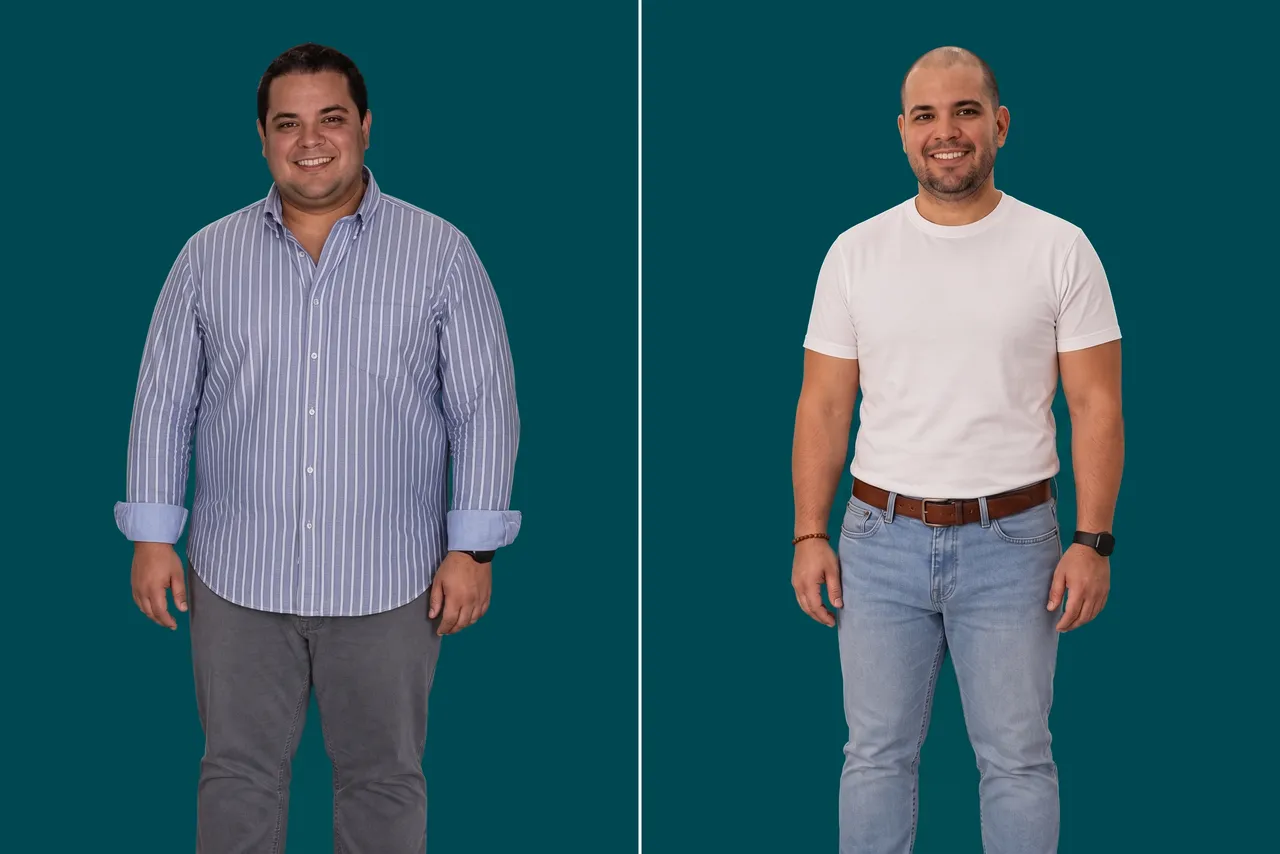 Weight Loss Surgery-Gastric Sleeve 3