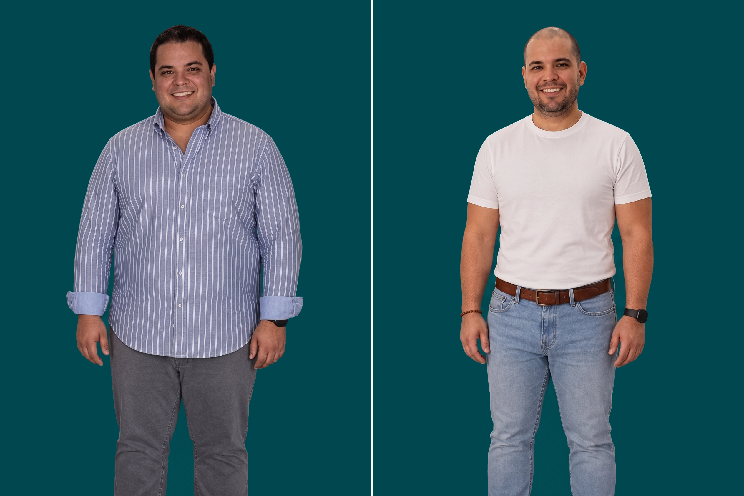 Weight Loss Surgery-Gastric Sleeve 3