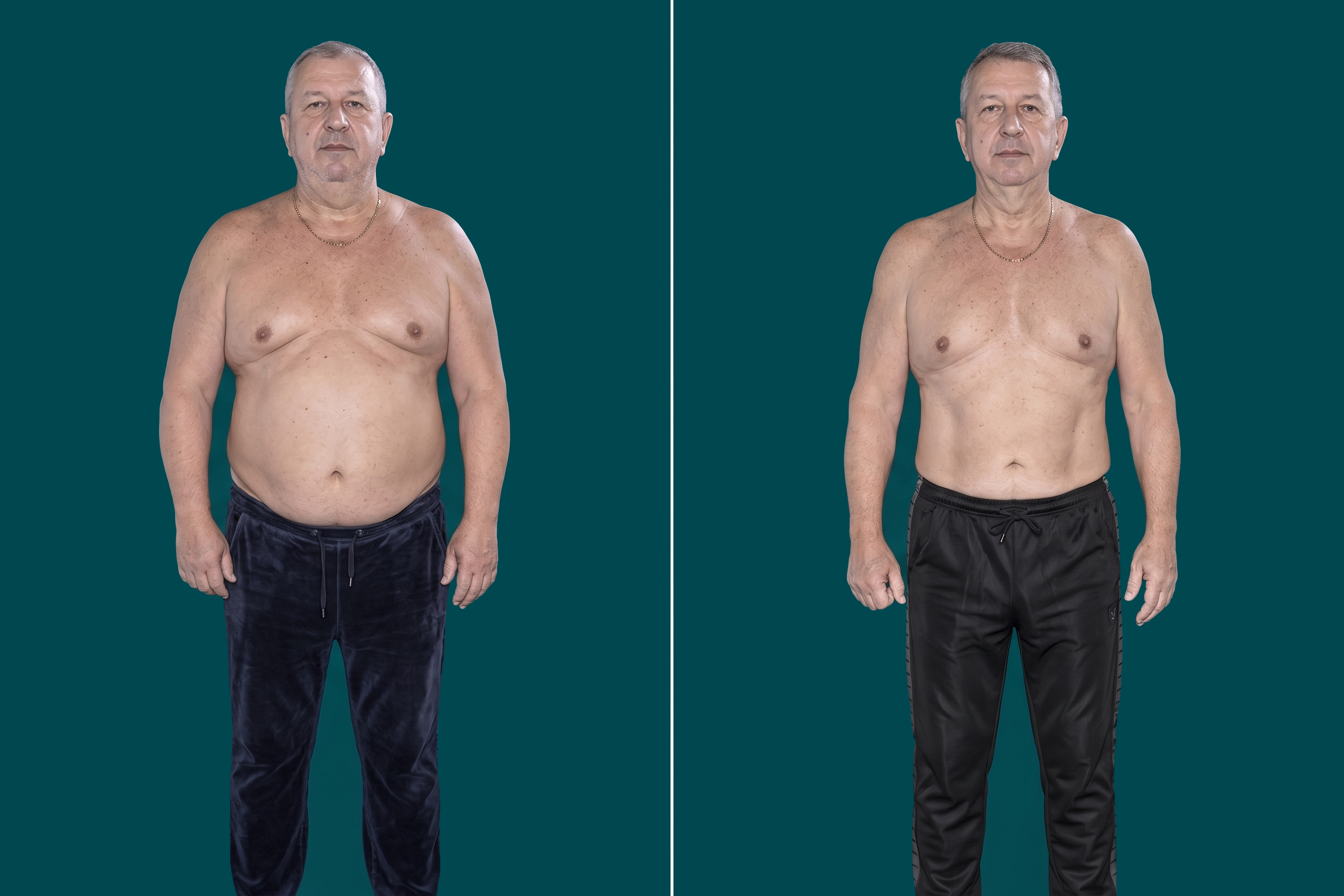 Weight Loss Surgery 14