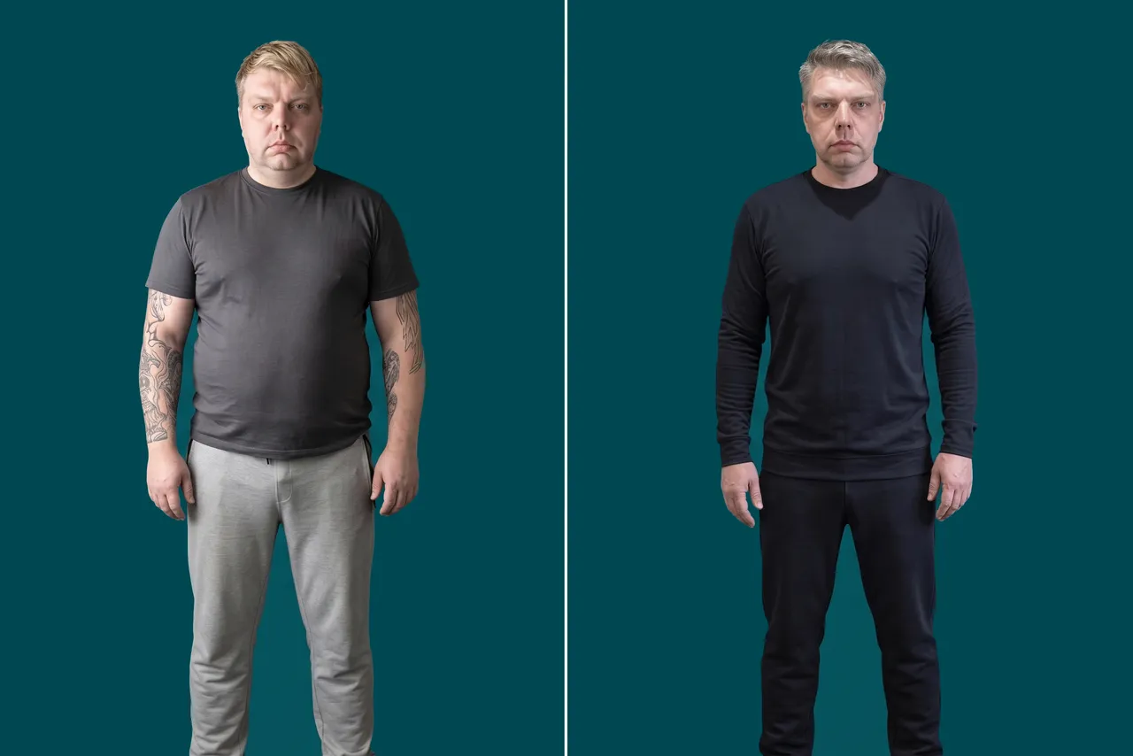 Weight Loss Surgery 15
