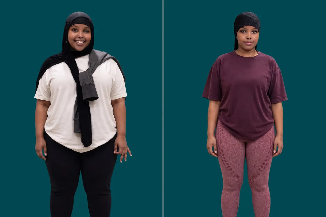Weight Loss Surgery-Gastric Bypass 3