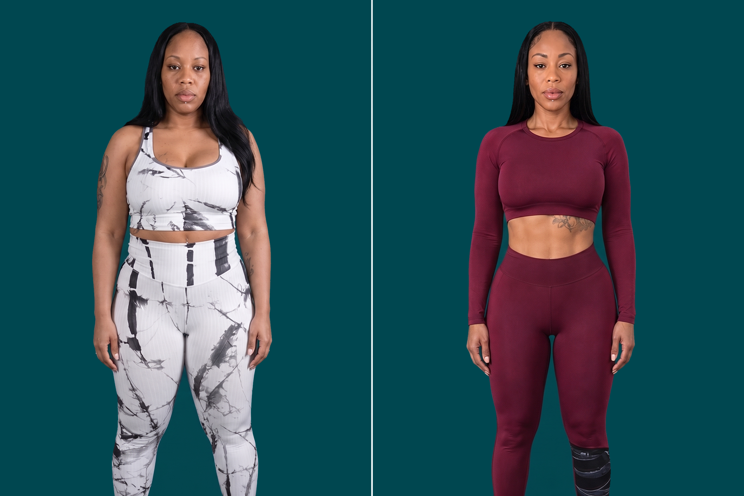 Weight Loss Surgery-Gastric Botox 1