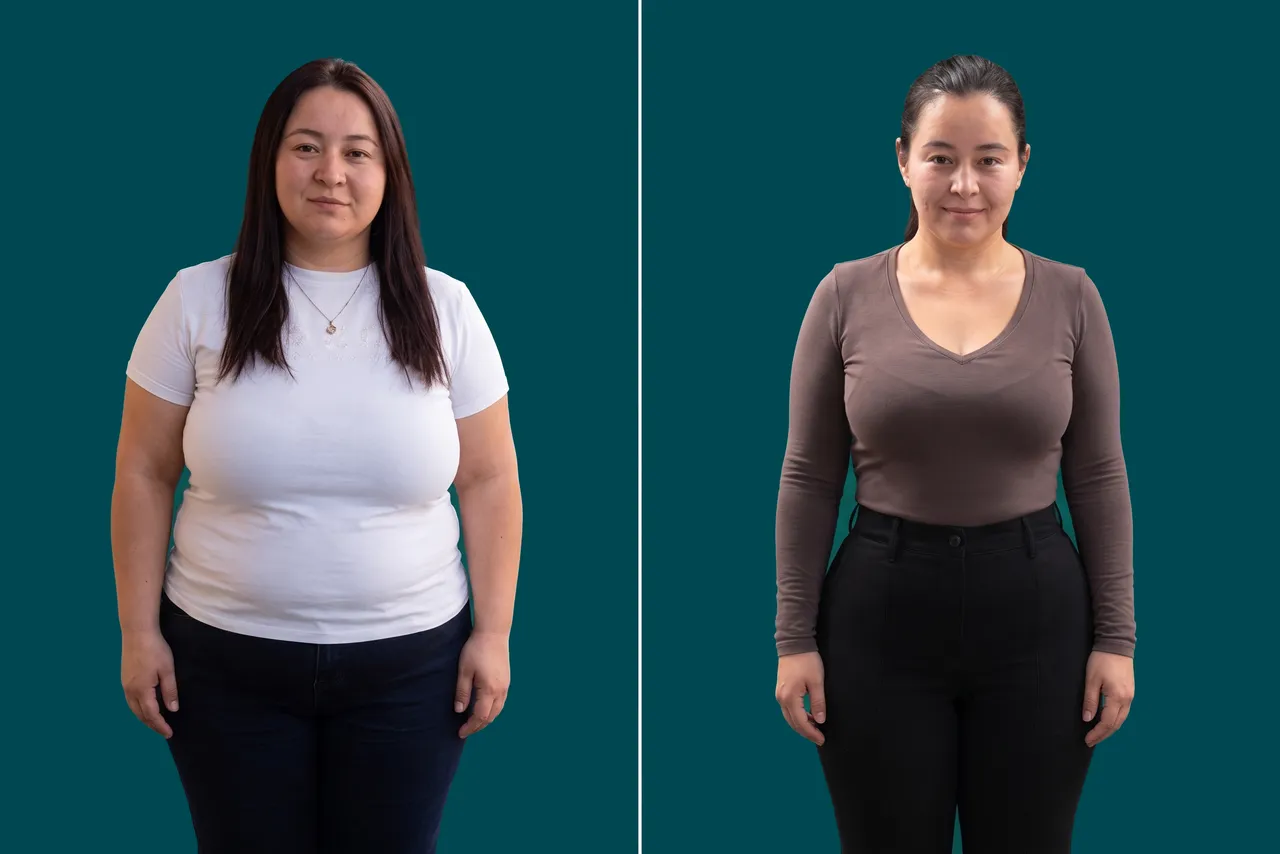 Weight Loss Surgery-Gastric Botox 2