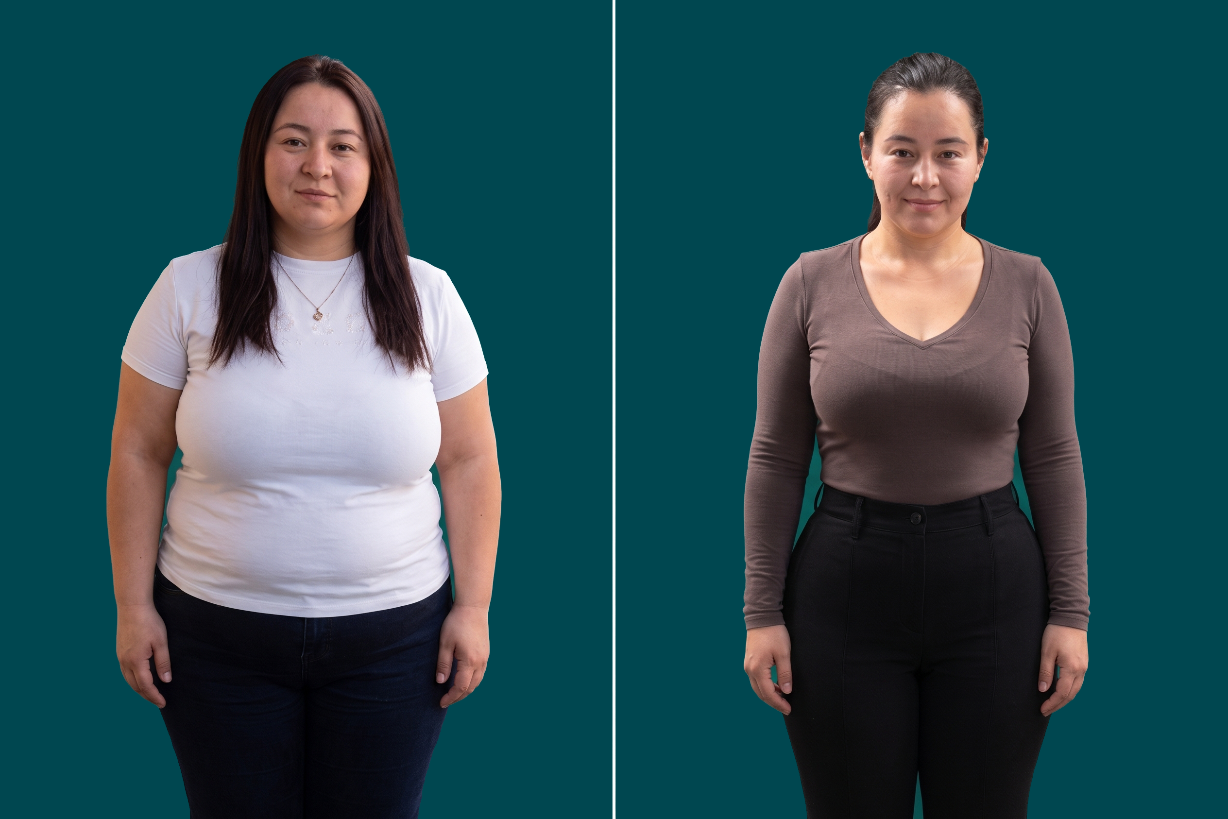 Weight Loss Surgery-Gastric Botox 2