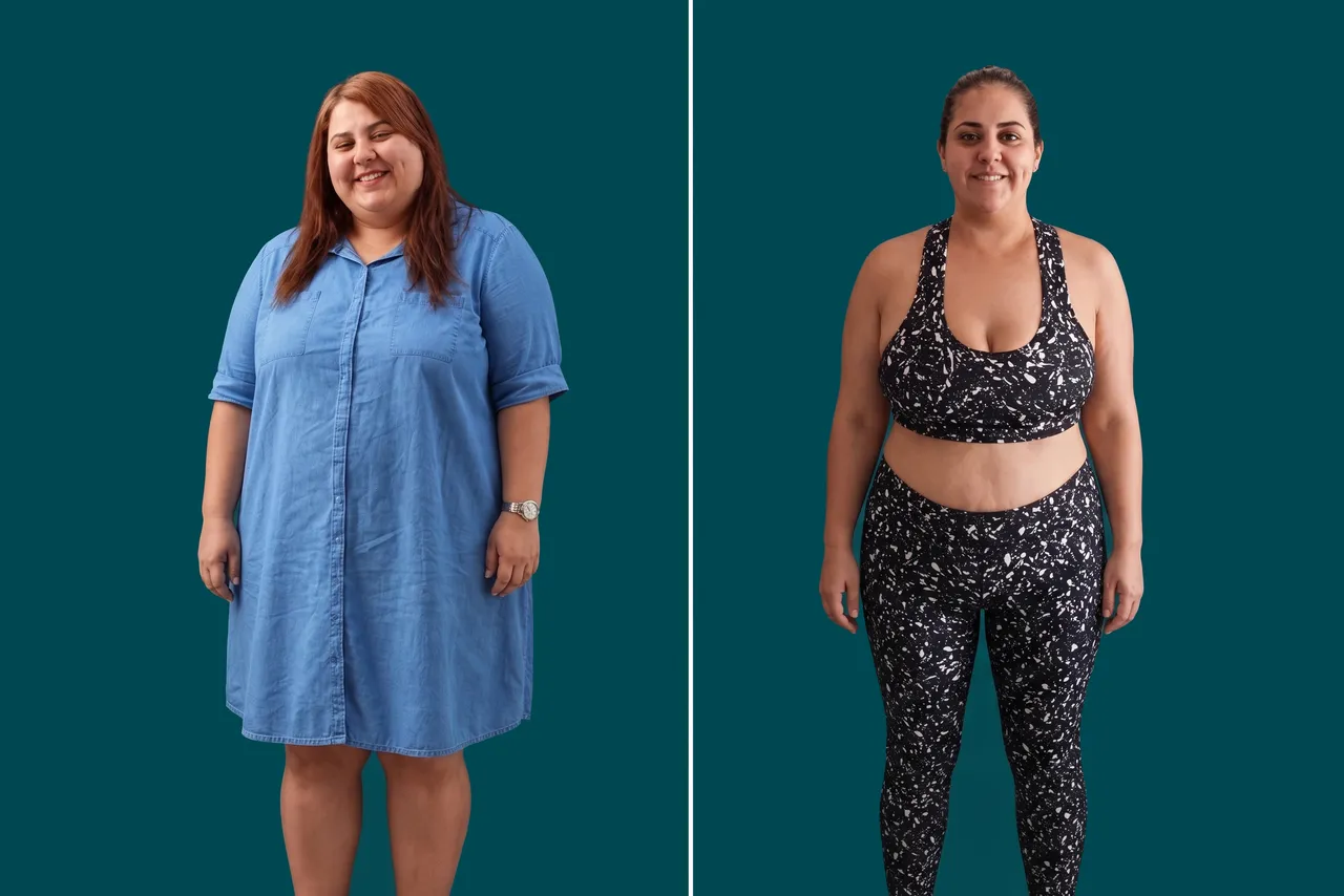 Weight Loss Surgery-Gastric Balloon 1