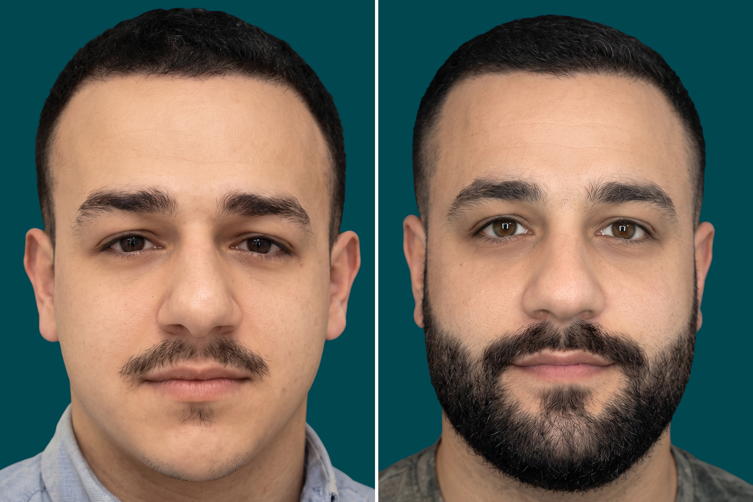 Beard Transplant 1