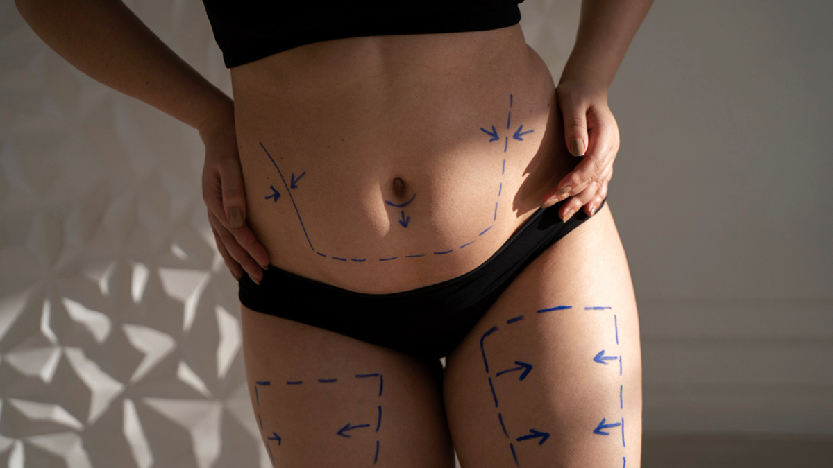Belly Liposuction şn turkey