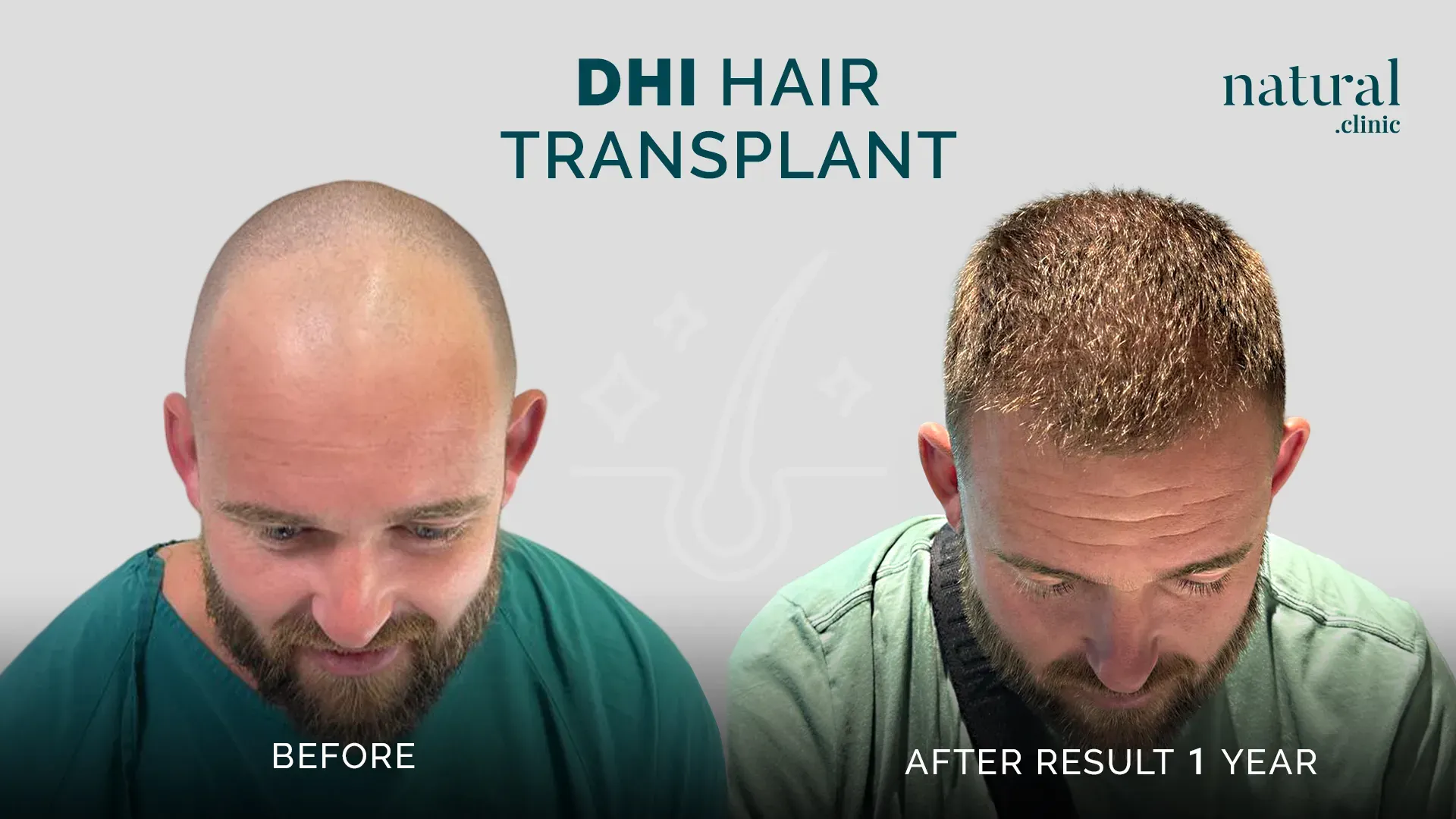 Unshaven Hair Transplant: DHI Hair Transplant in Turkey
