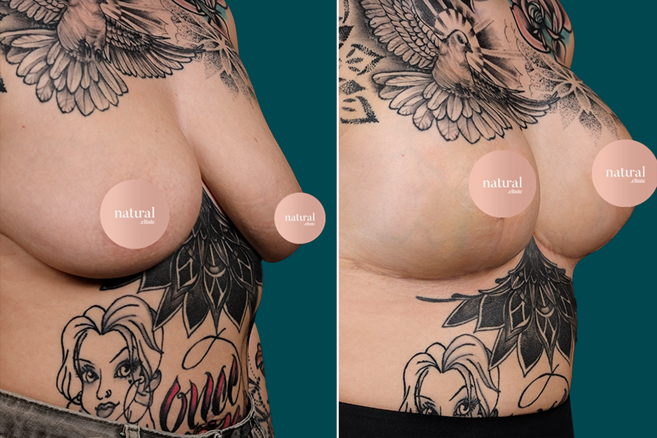 Breast Augmentation Before and After 1