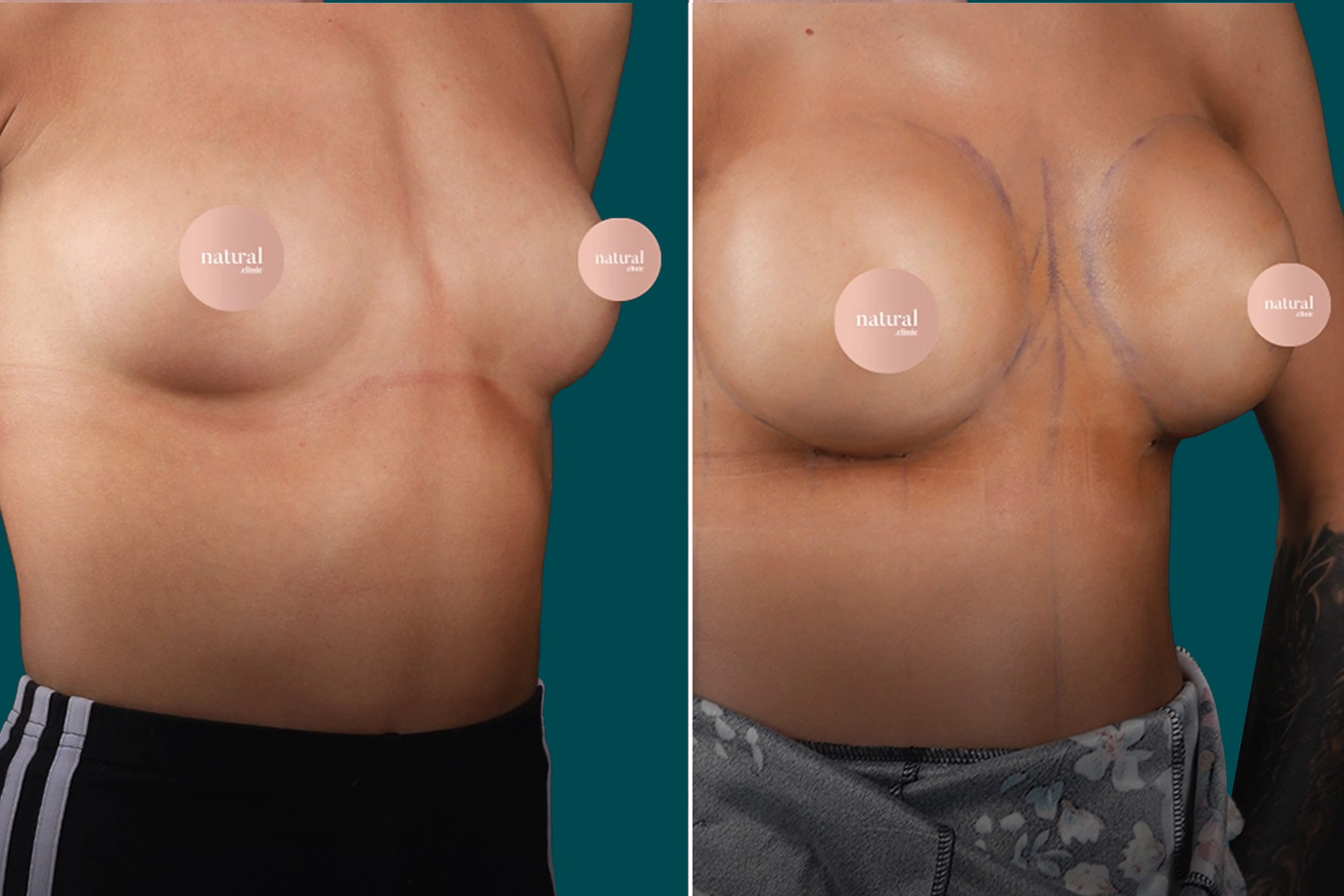 Breast Augmentation Before and After 10