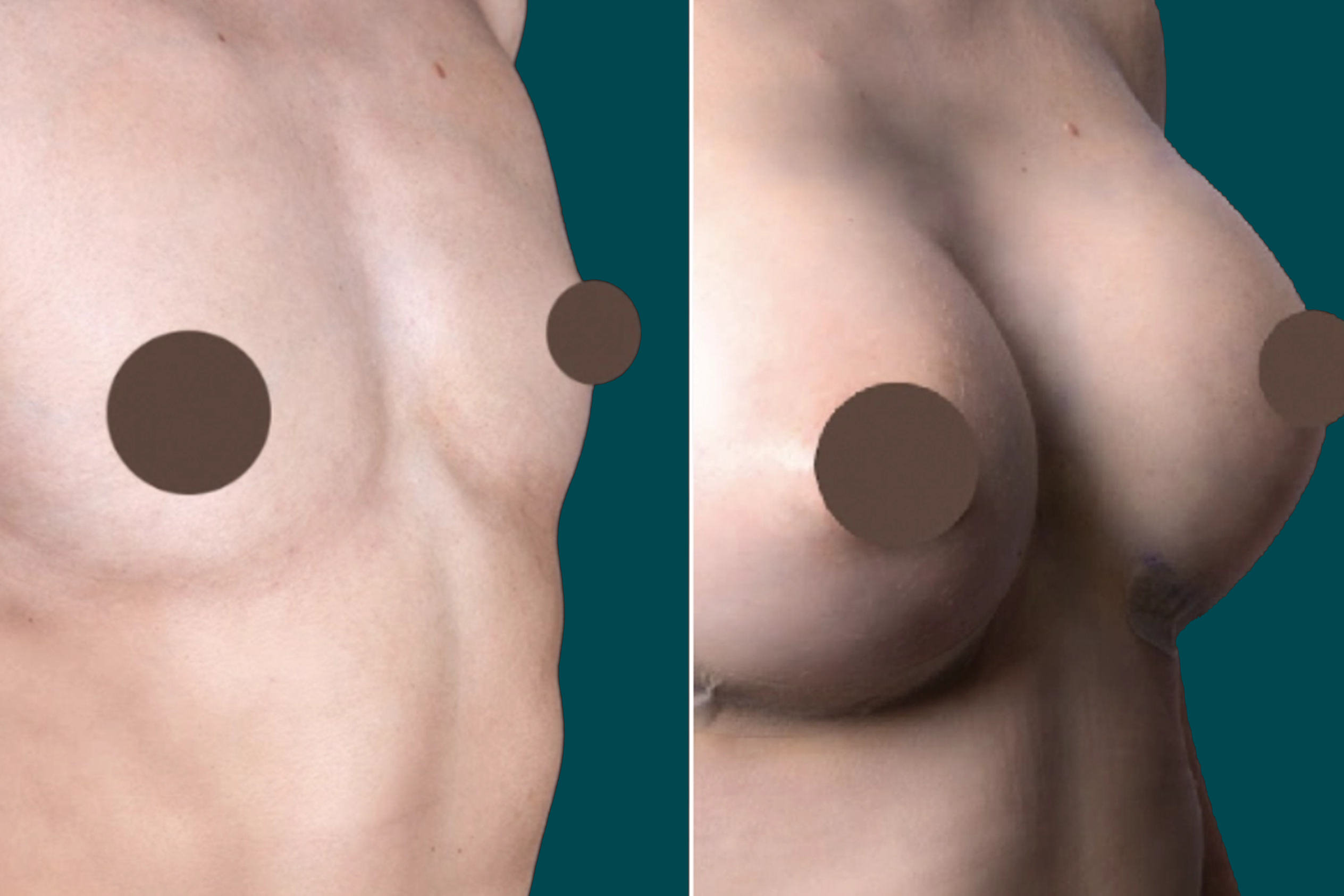 Breast Augmentation Before and After 11