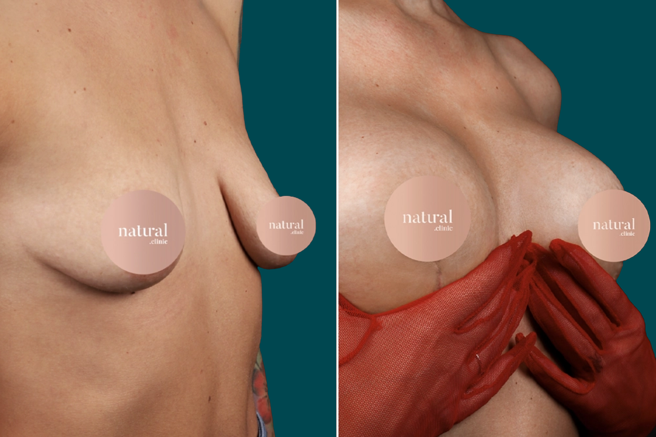 Breast Augmentation Before and After 12