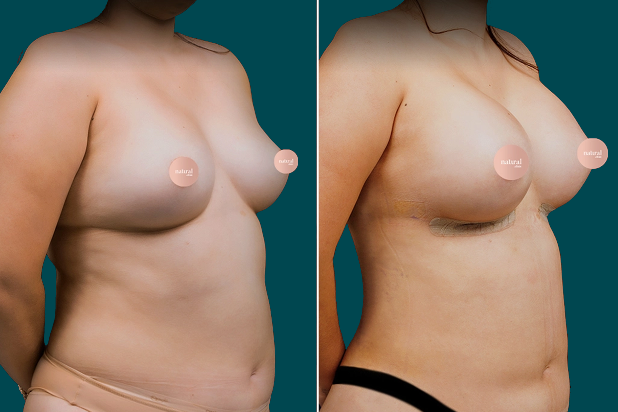 Breast Augmentation Before and After 13