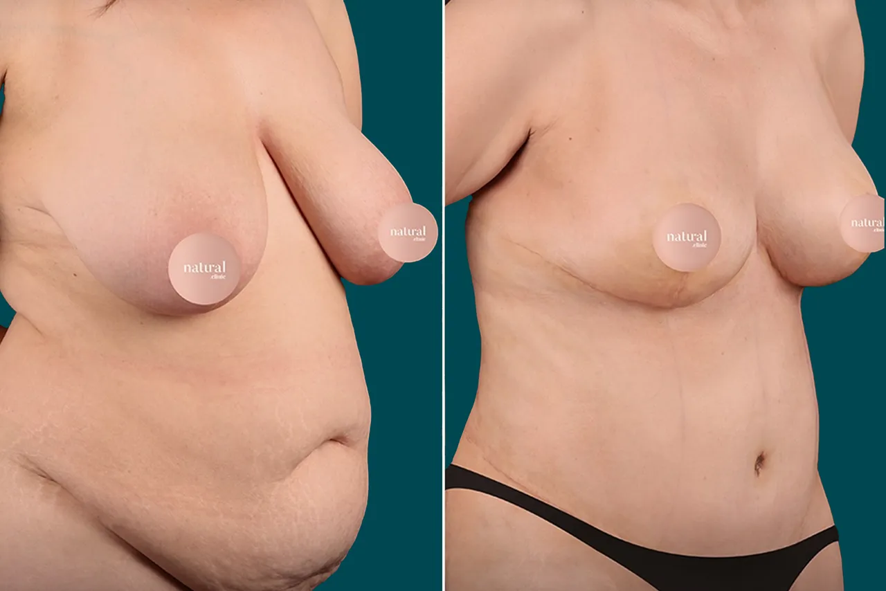 Breast Augmentation Before and After 14