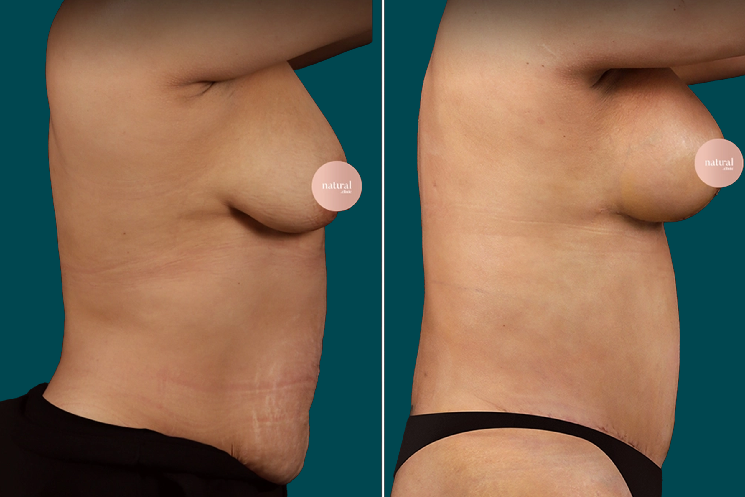 Breast Augmentation Before and After 15