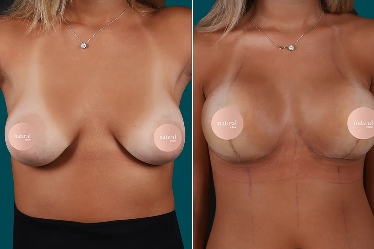 Breast Augmentation Before and After 16