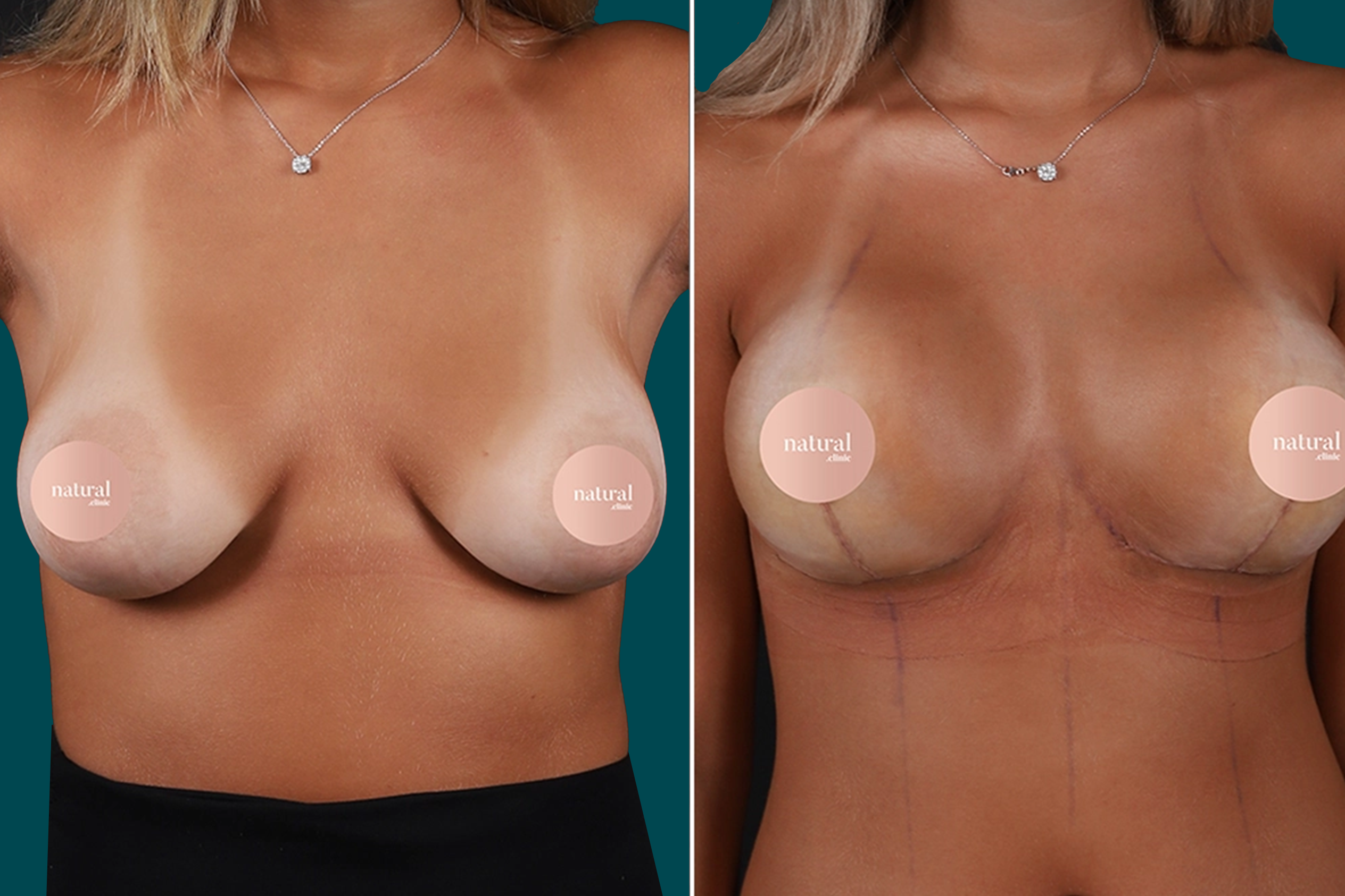 Breast Augmentation Before and After 16