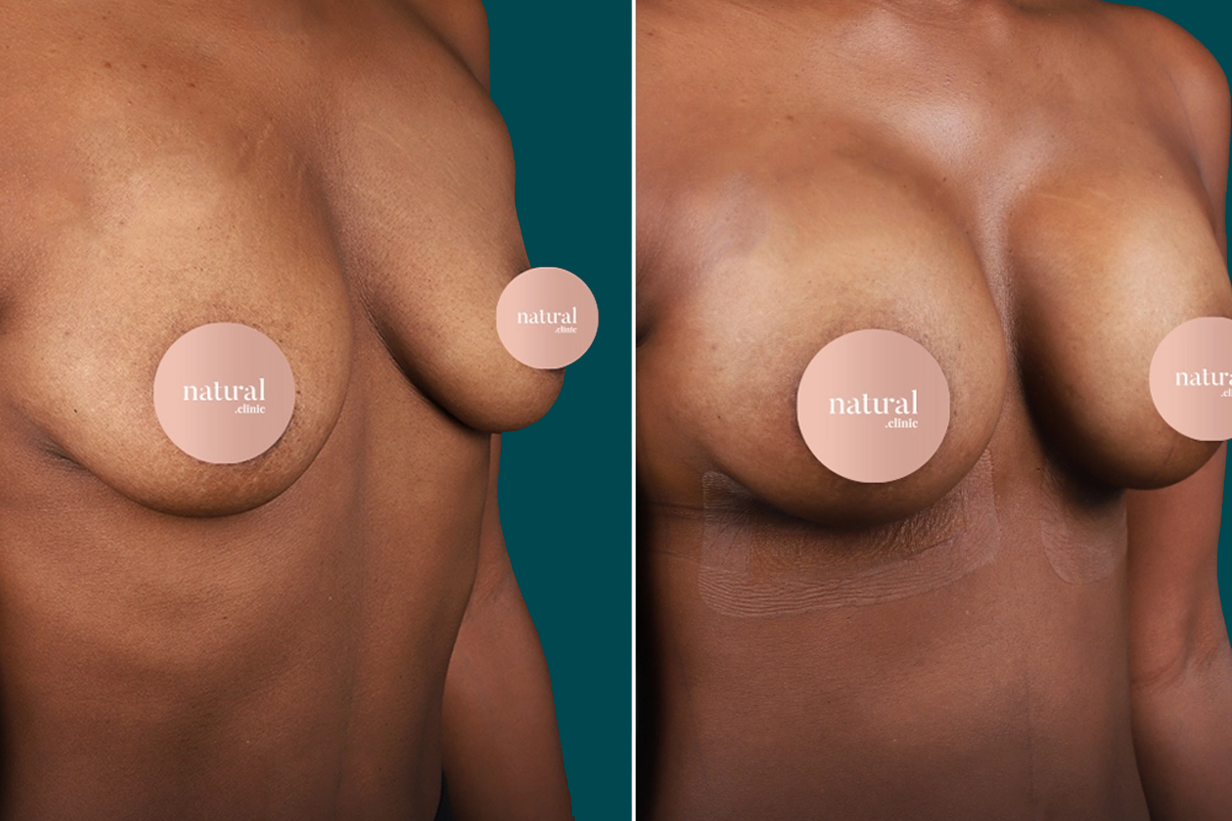 Breast Augmentation Before and After 2