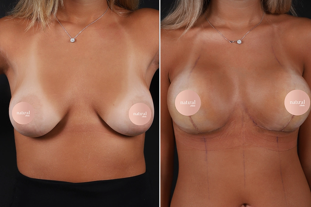 Breast Augmentation Before After In Turkey 25
