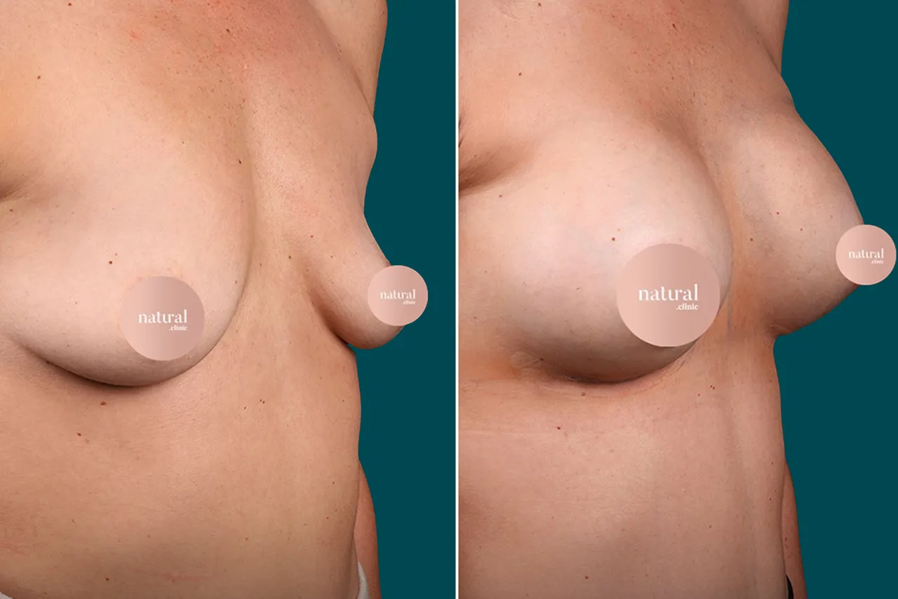 Breast Augmentation Before and After 3