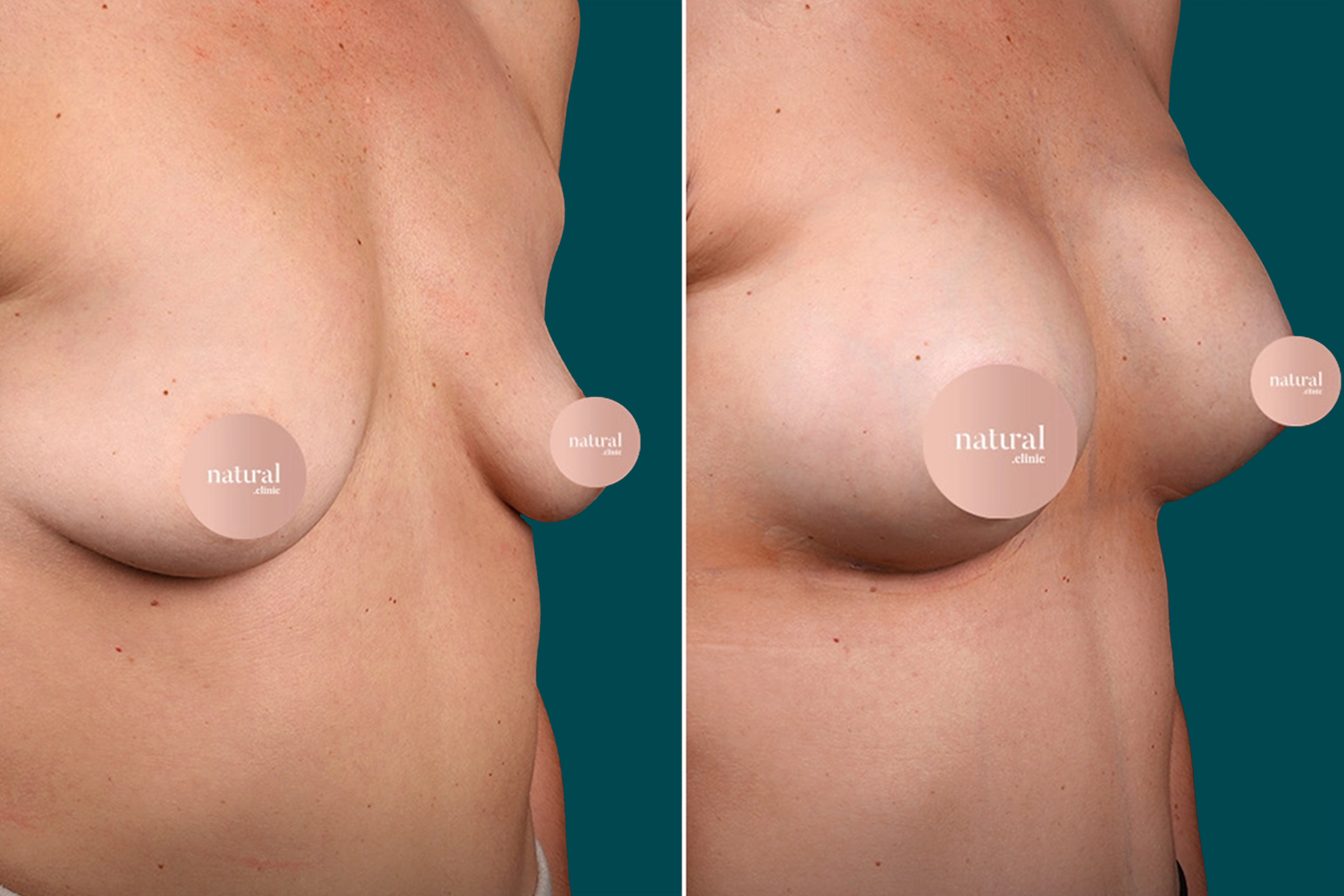 Breast Augmentation Before and After 3