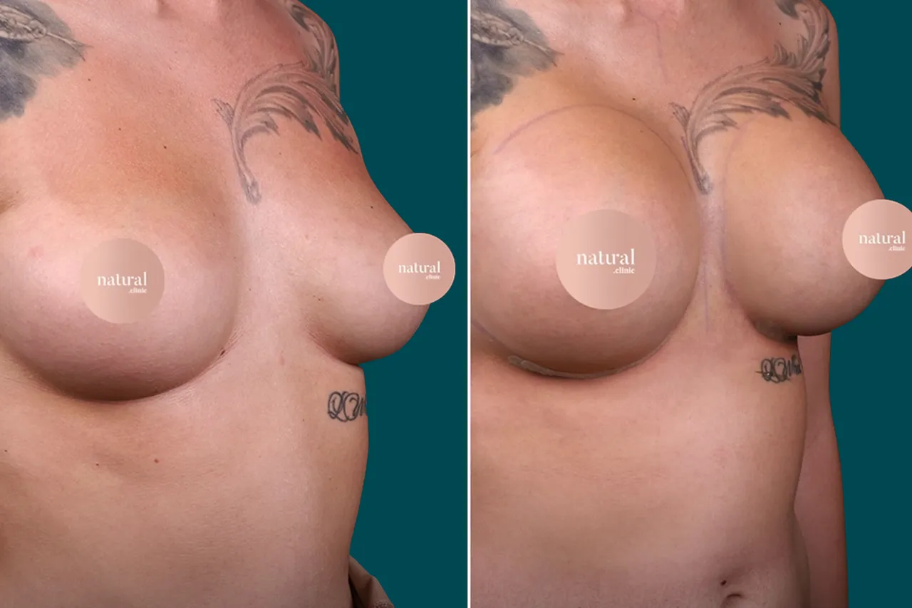 Breast Augmentation Before and After 5