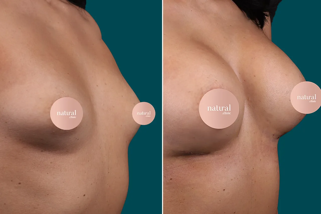 Breast Augmentation Before and After 6