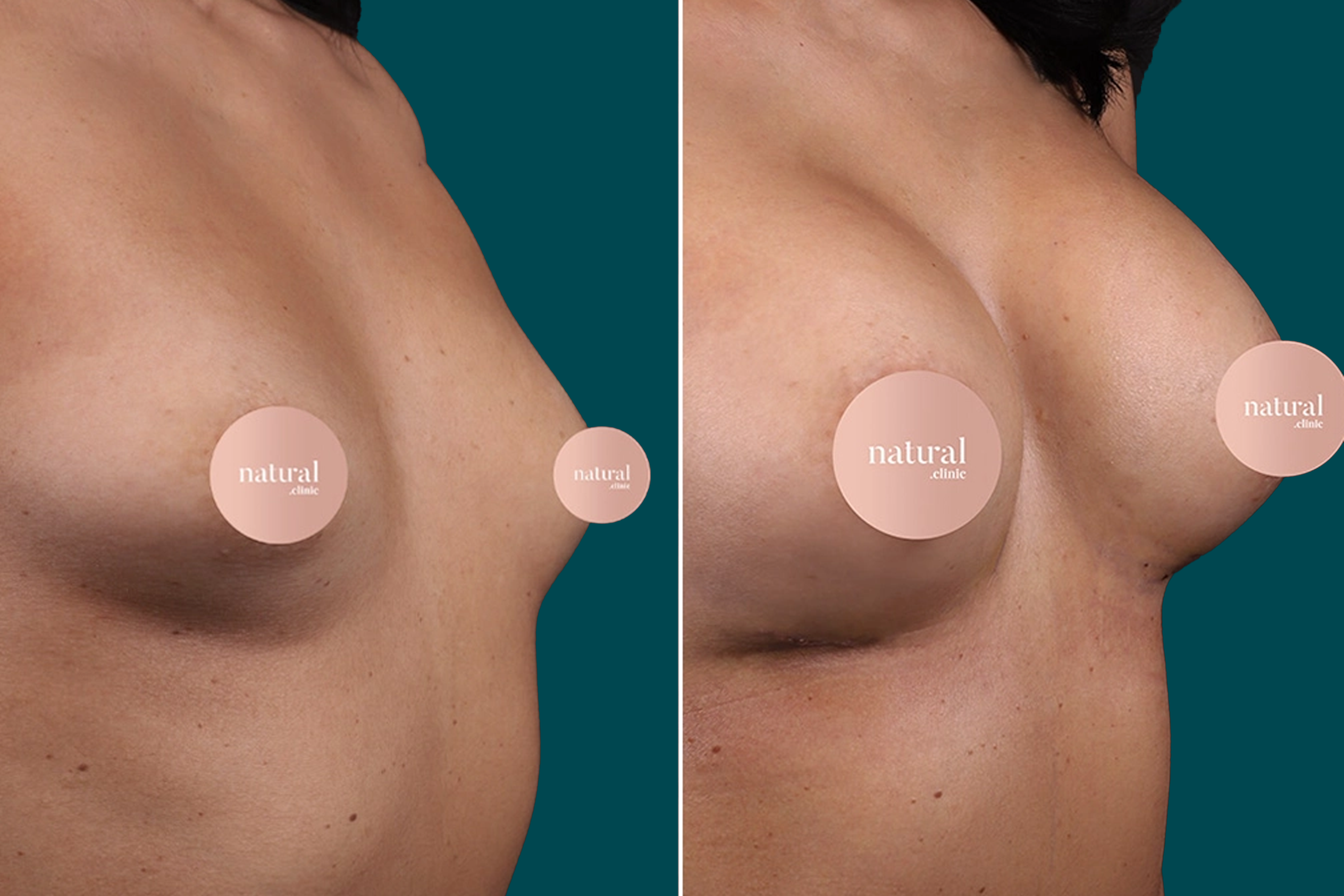 Breast Augmentation Before and After 6
