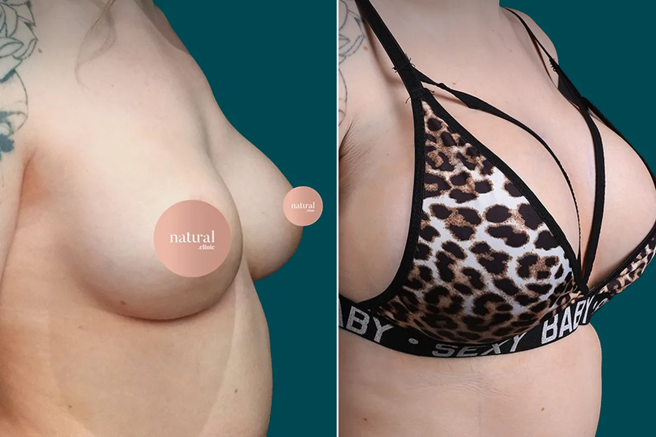 Breast Augmentation Before and After 7