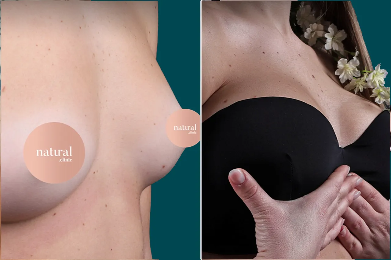 Breast Augmentation Before and After 8