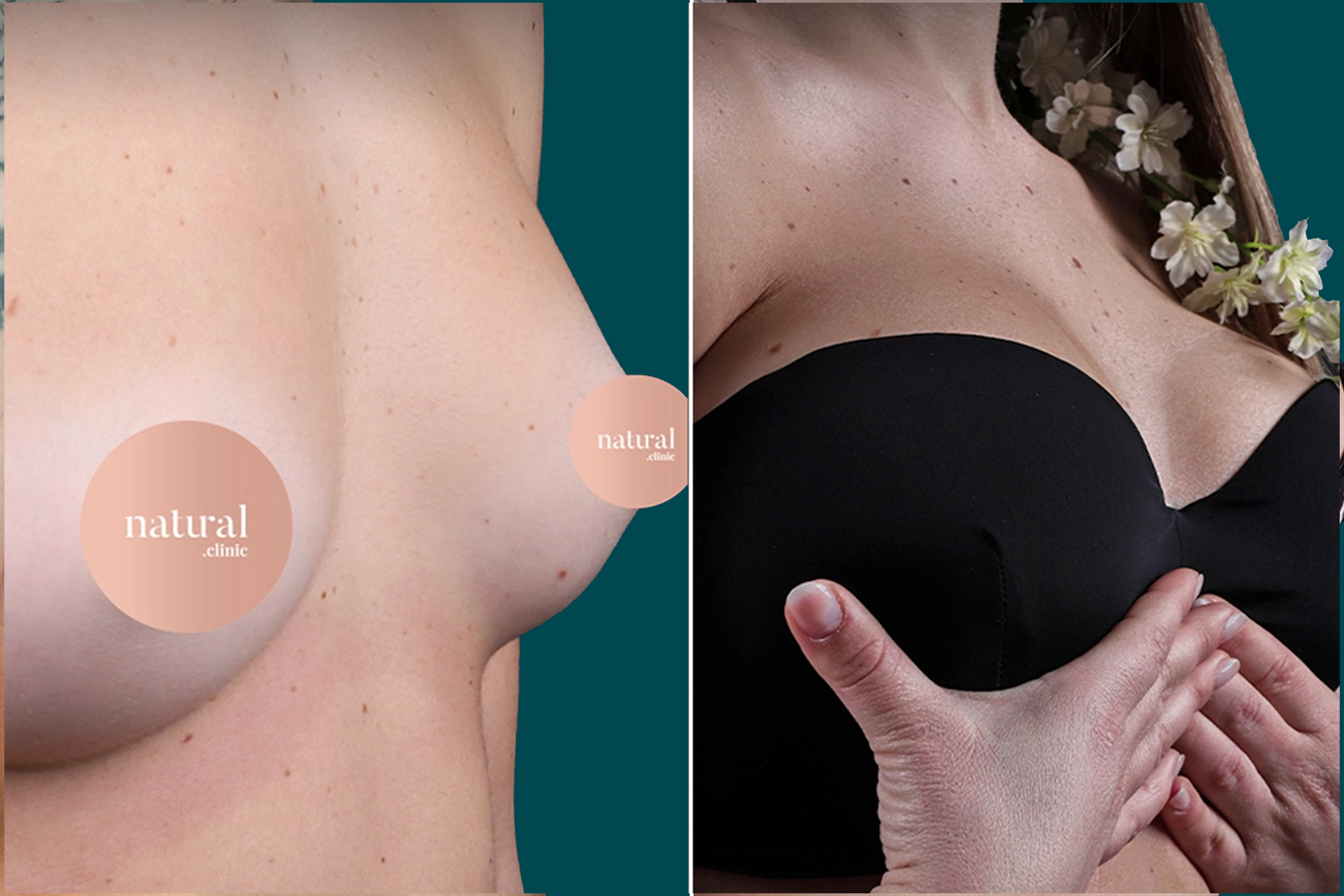 Breast Augmentation Before and After 8