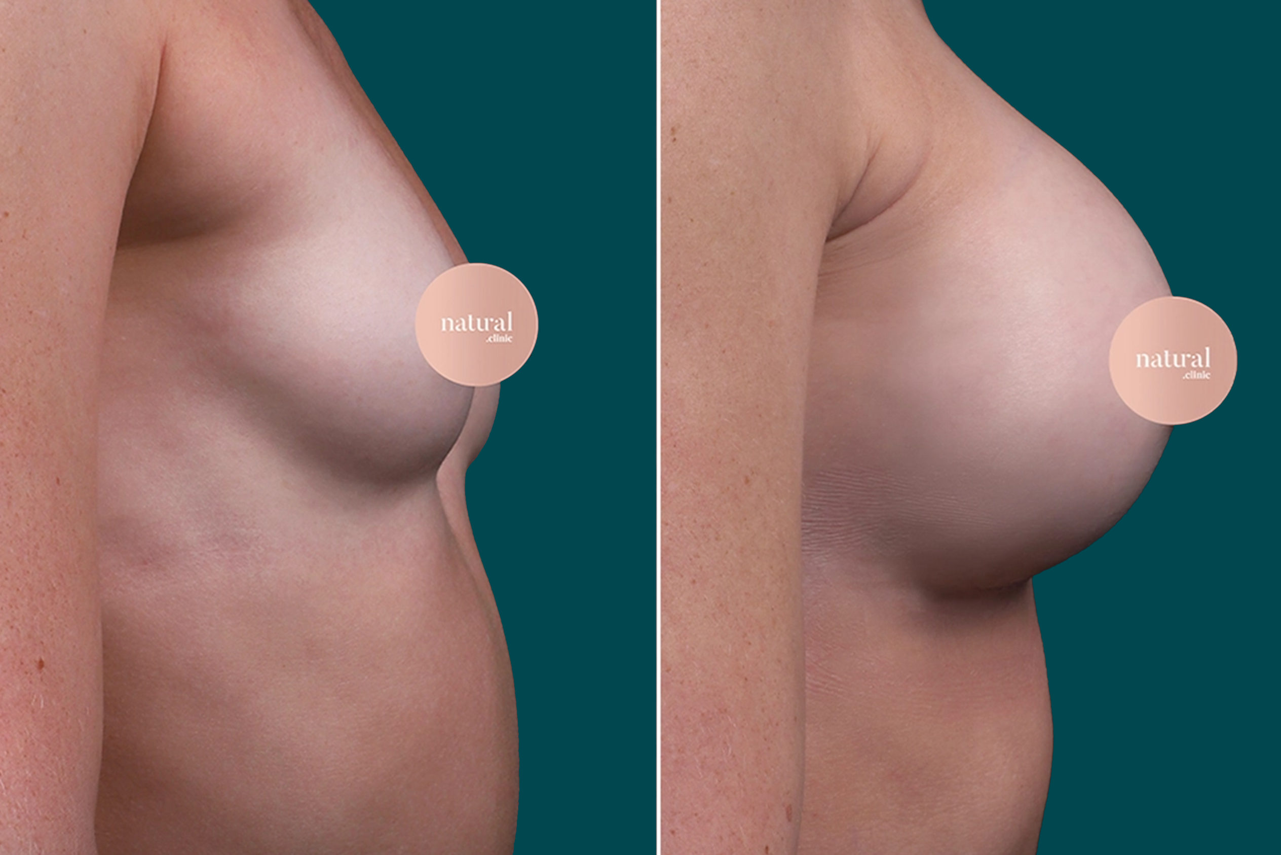 Breast Augmentation Before and After 9