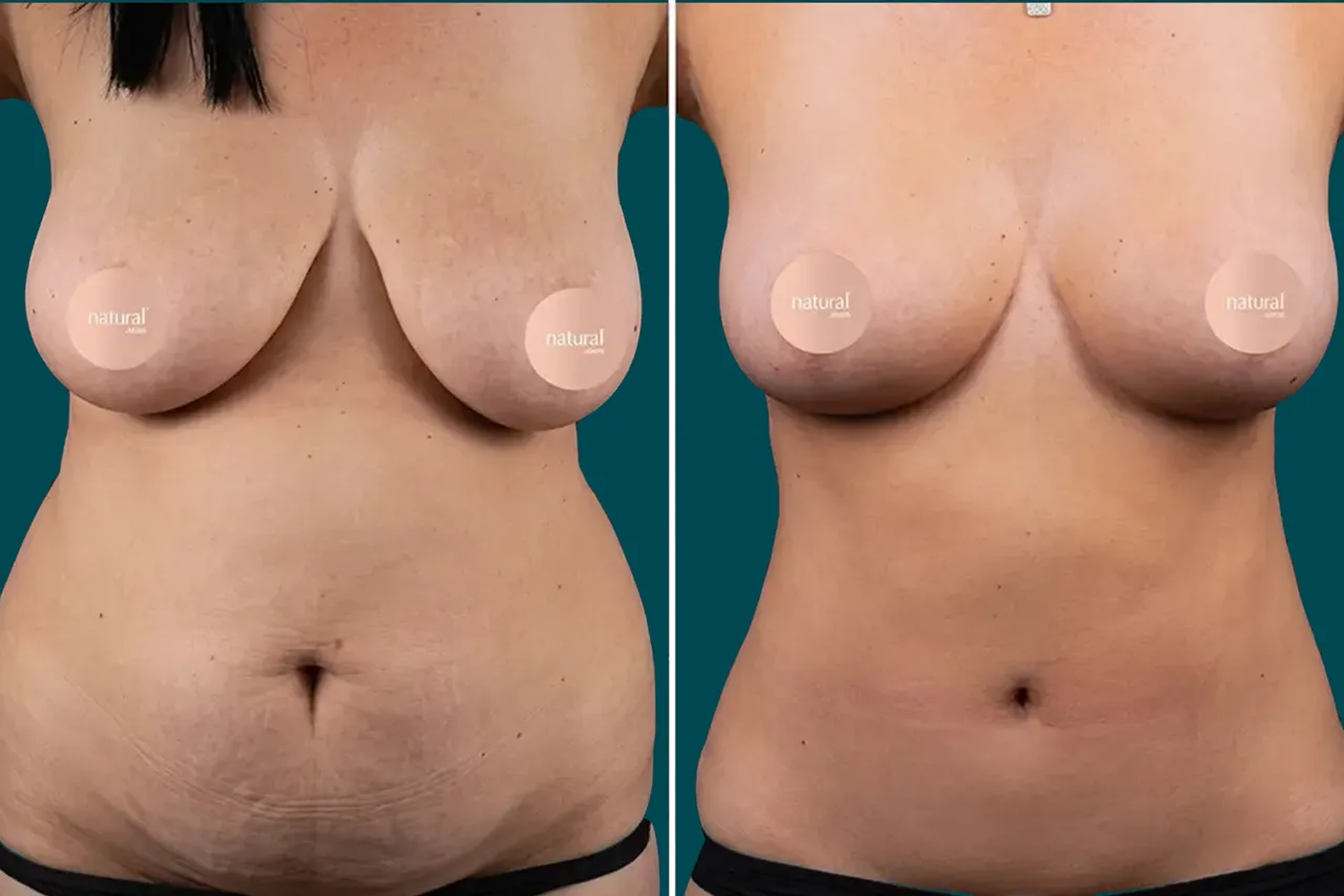 Breast Lift Before and After 1