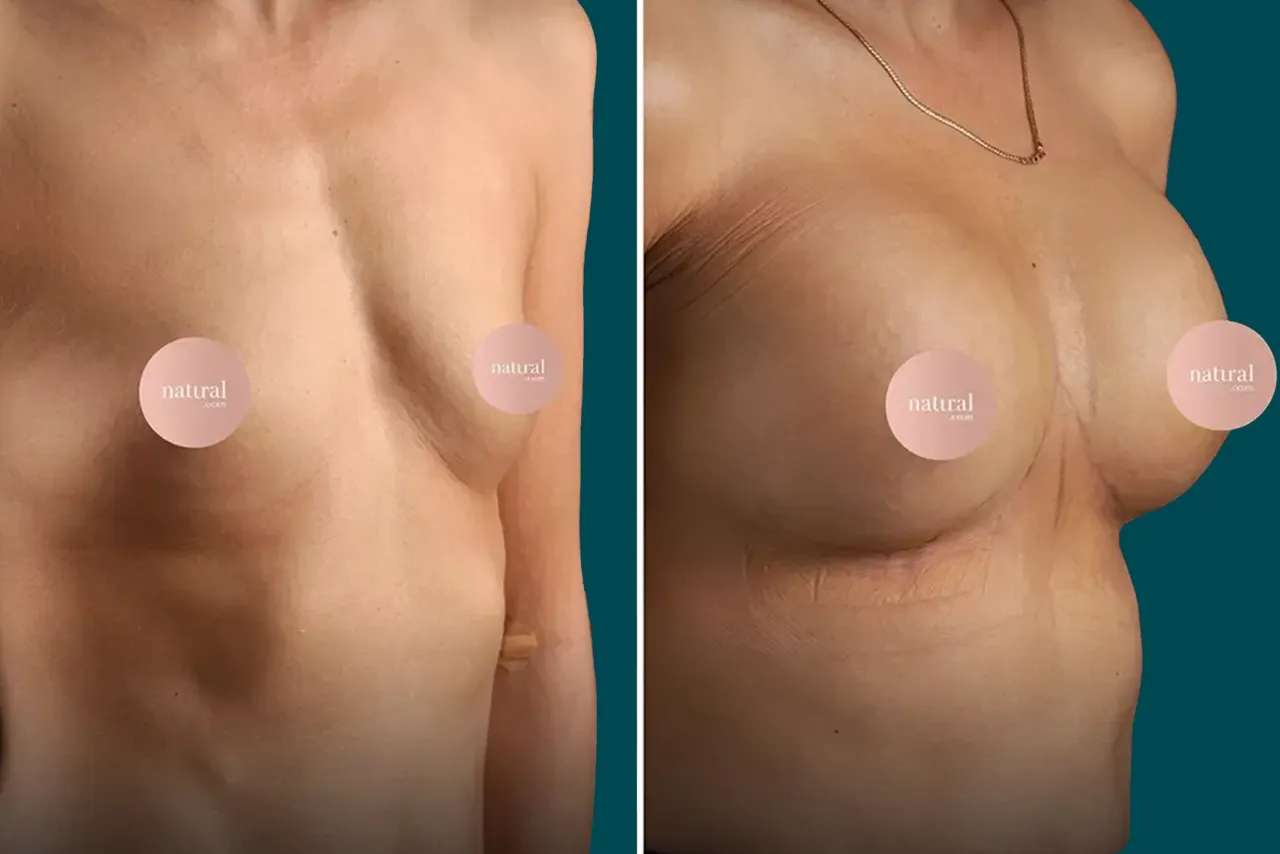 Breast Lift Before and After 4