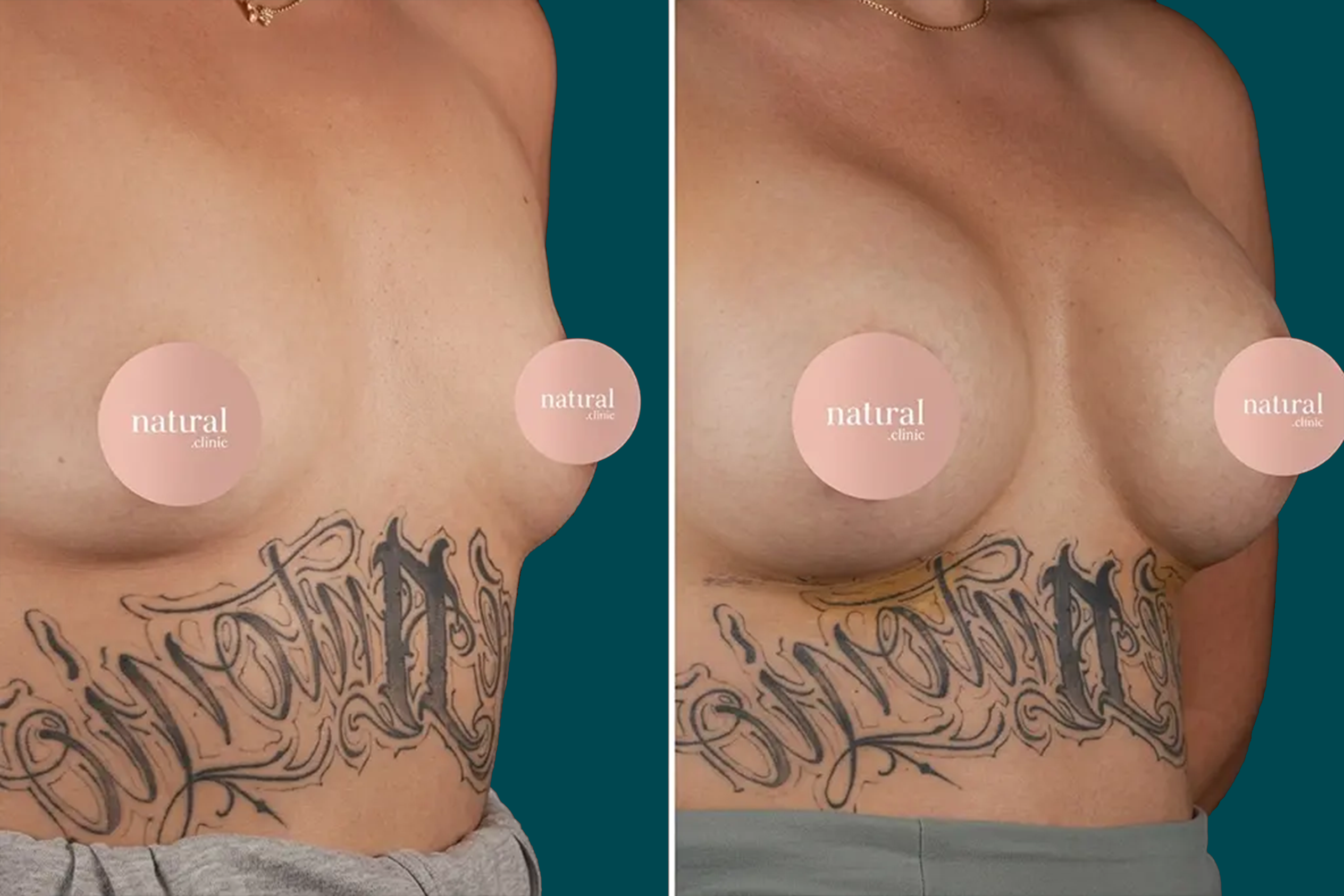 Breast Lift Before and After 6