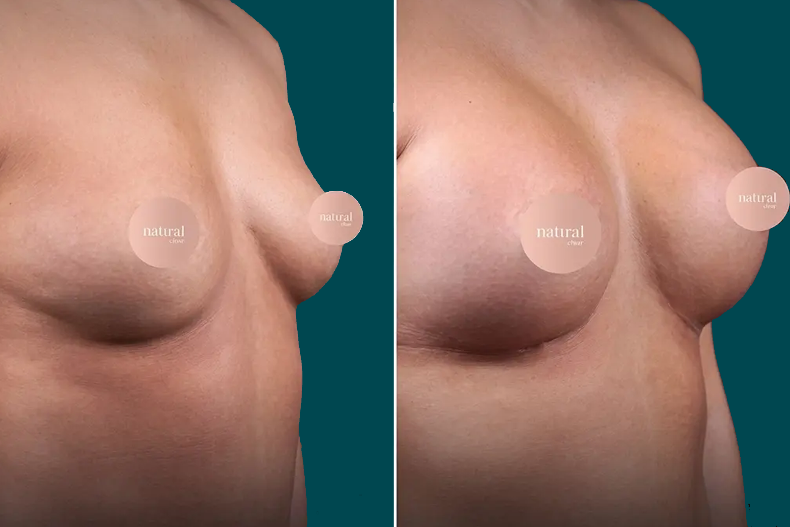 Breast Lift Before and After 7