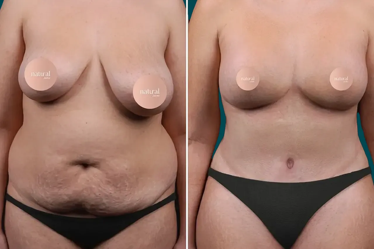 Breast Lift Before and After 8