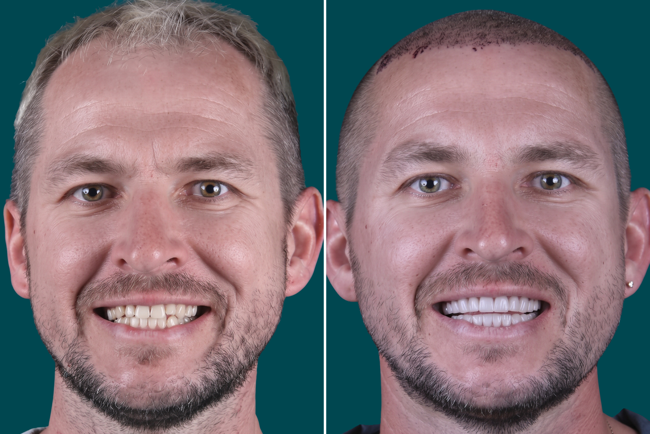 Dental Veneers-Composite Veneers 2