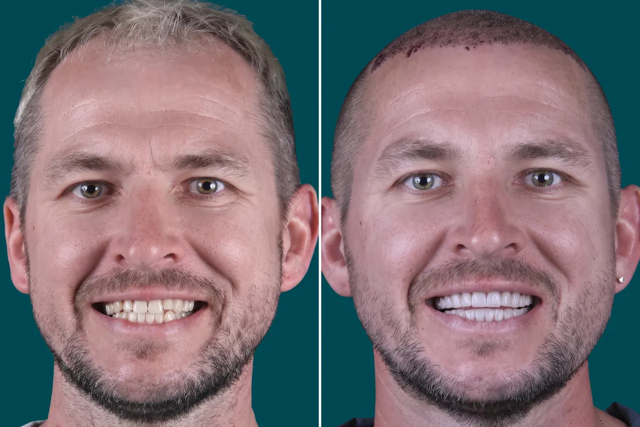 Dental Veneers 8