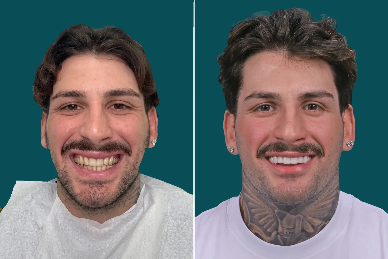 Dental-Veneers-Composite Veneers 1