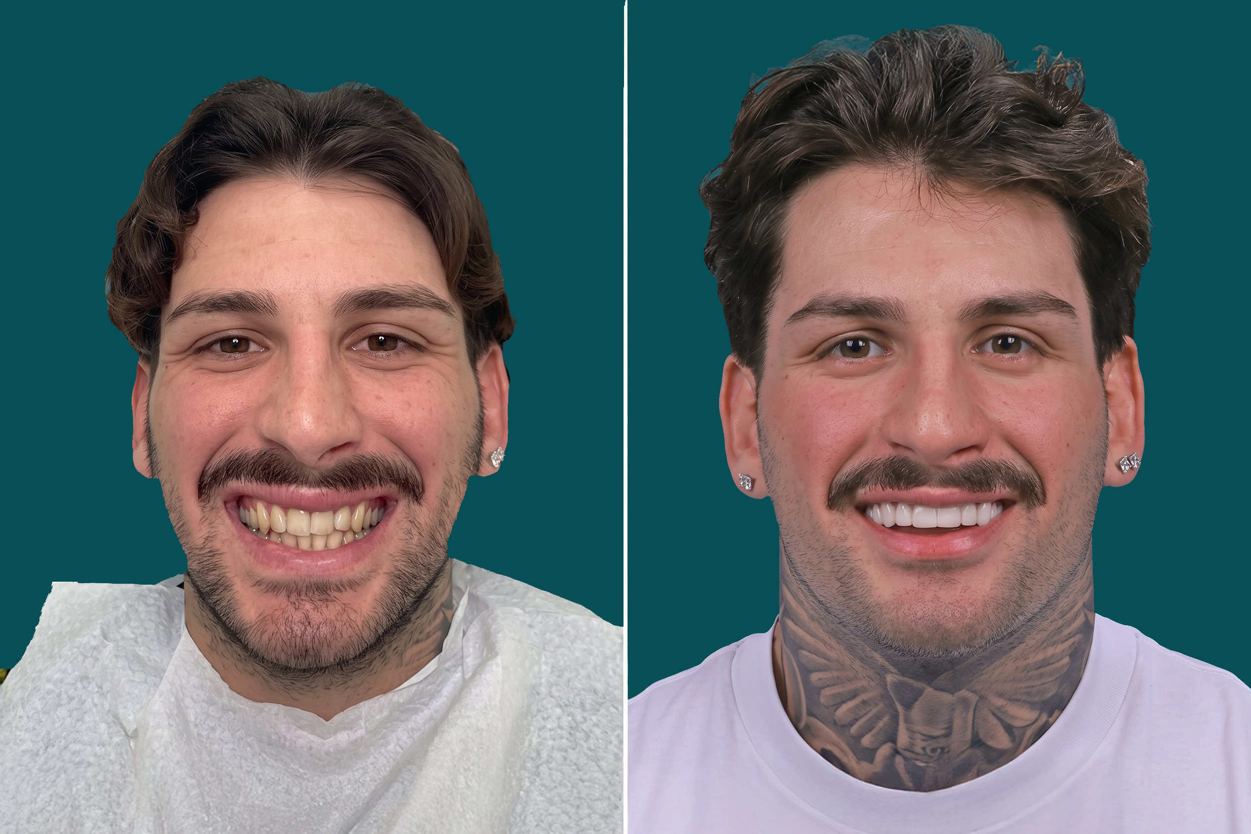 Dental-Veneers-Composite Veneers 1