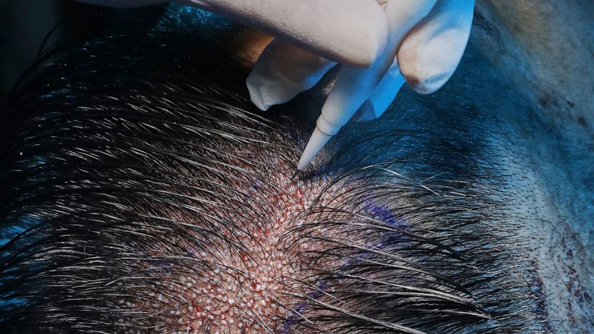 DHI Hair Transplant