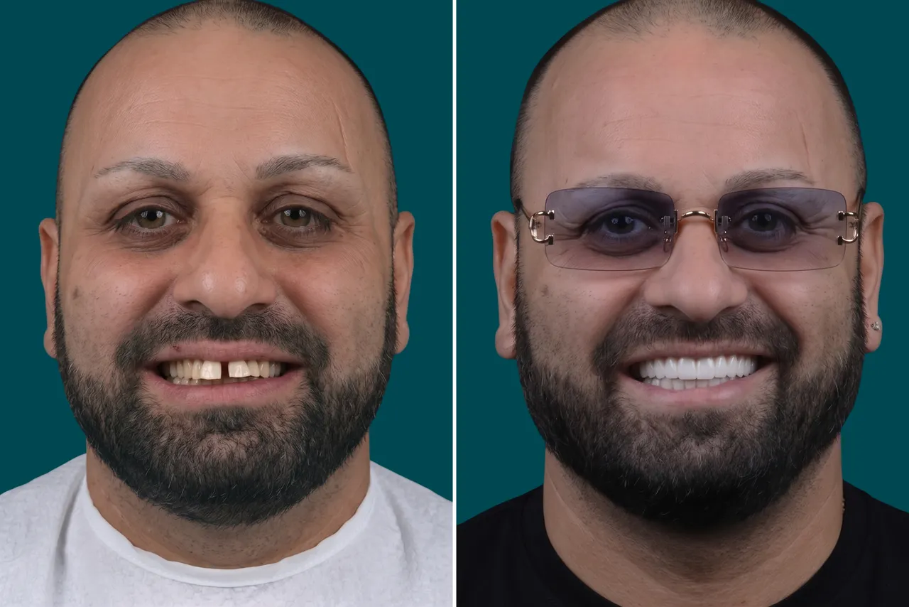 Dental-Crowns 2