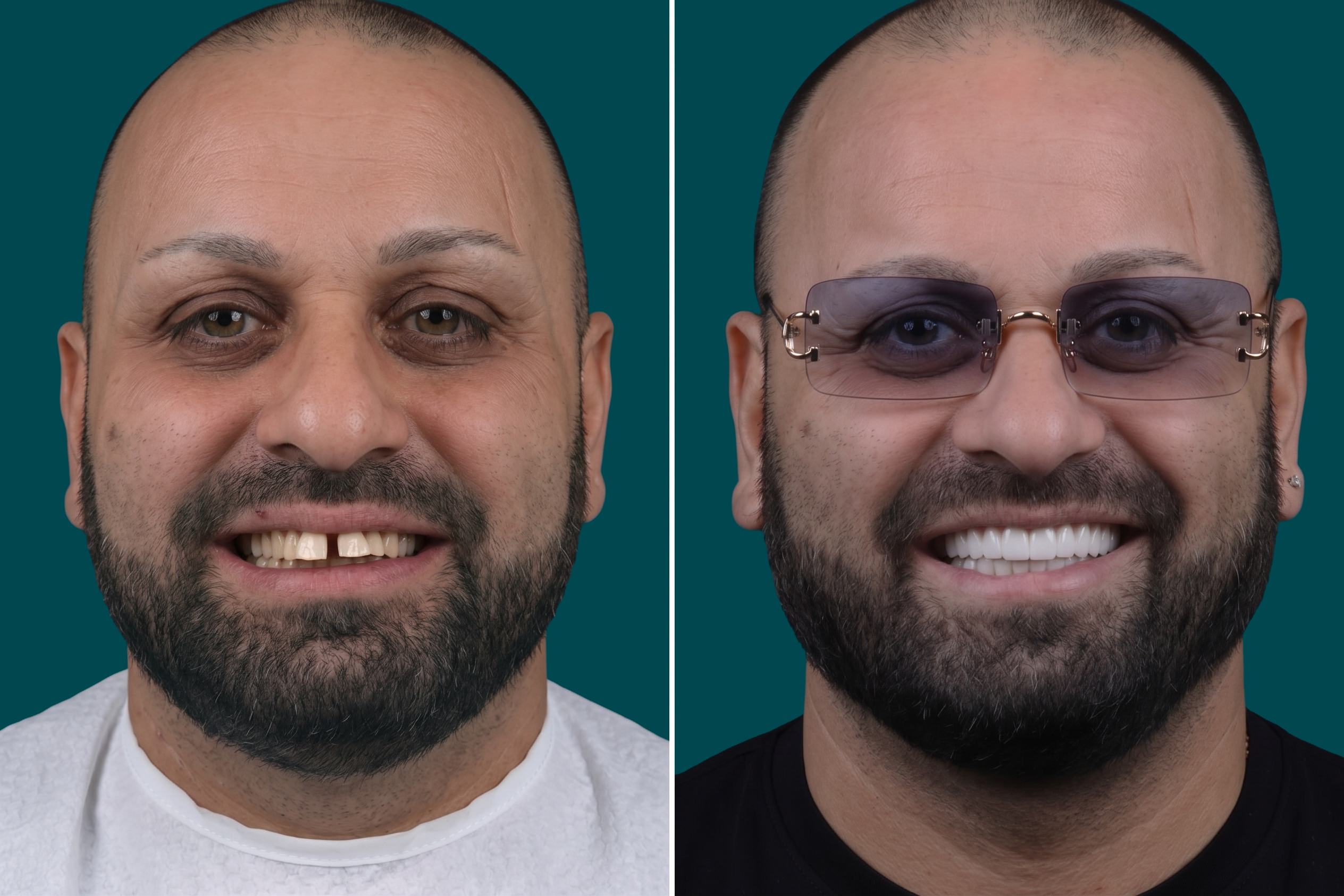 Dental-Crowns 2