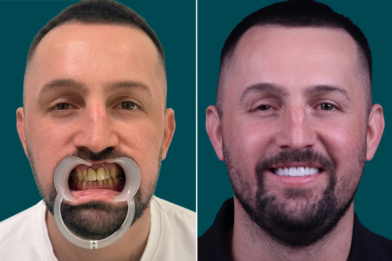 Dental-Crowns 3