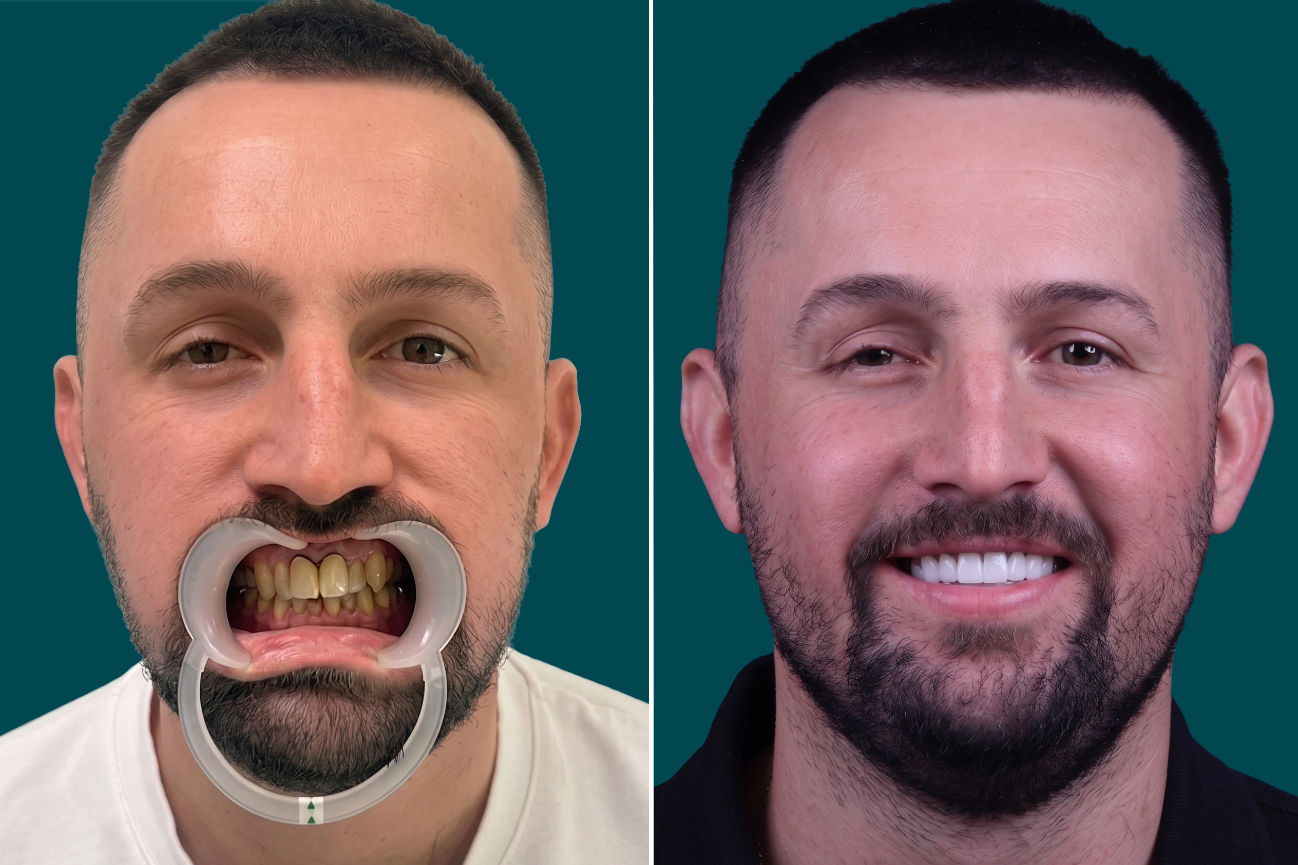 Dental-Crowns 3