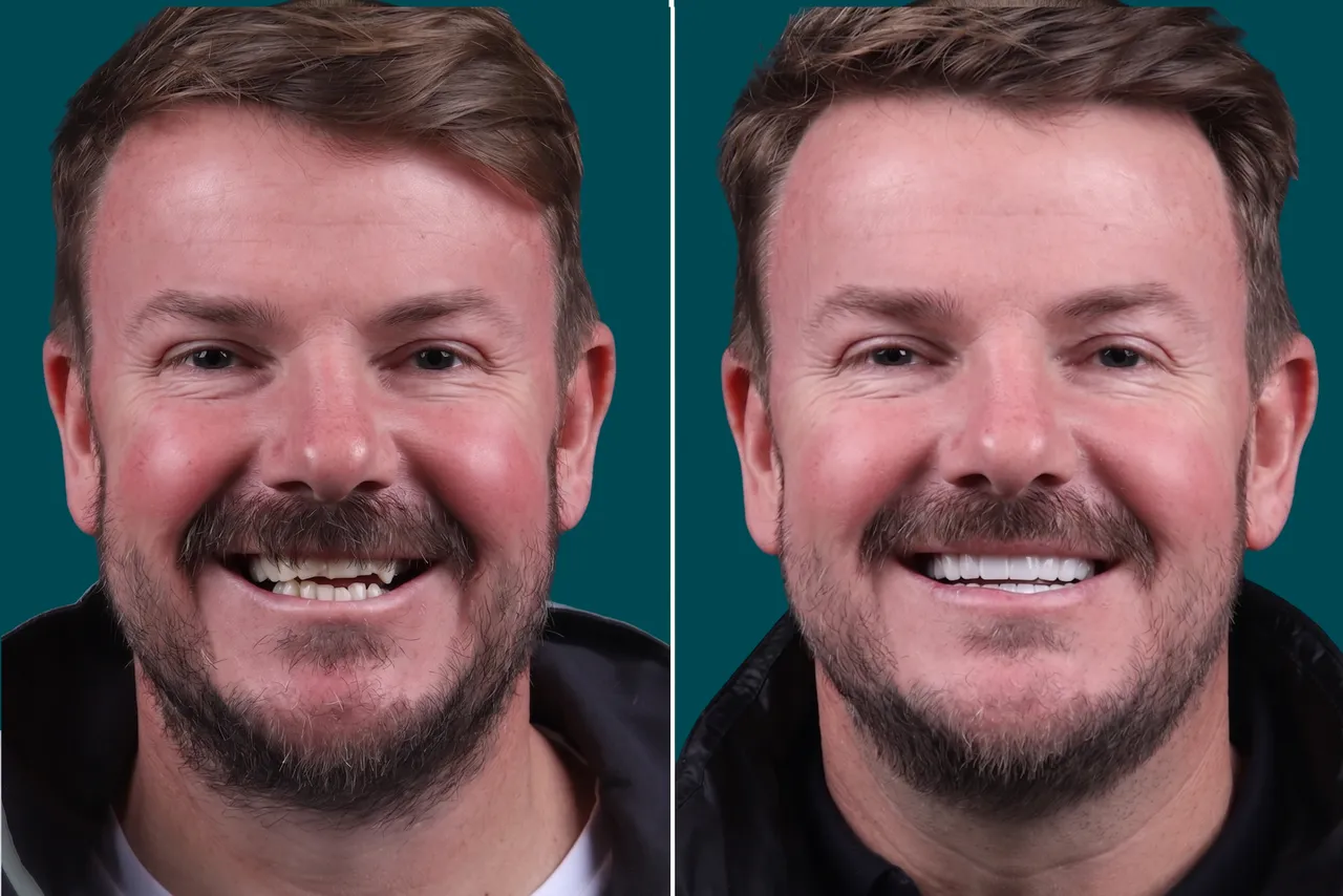 Dental-Crowns 5